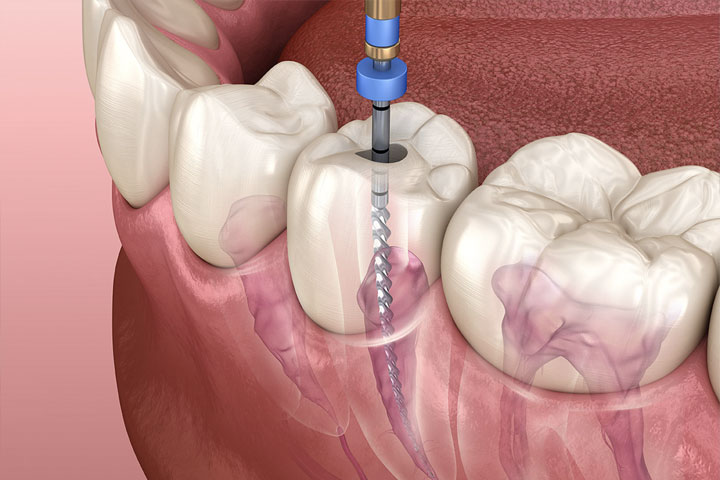 Dominic Sevilla DMD - Endodontics